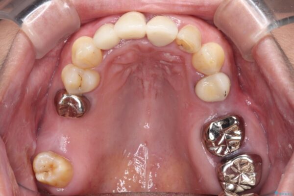 歯茎の縁に見える変色を隠したい　前歯のオールセラミッククラウン 治療後画像