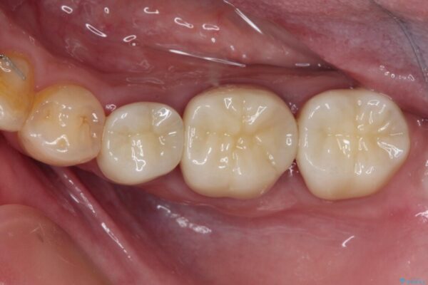 目立つ銀歯を白くしたい　奥歯のセラミック治療 治療後画像