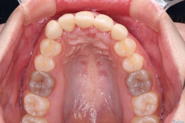 不揃いな前歯のセラミックが気になる　オールセラミッククラウンによる補綴治療 治療後画像