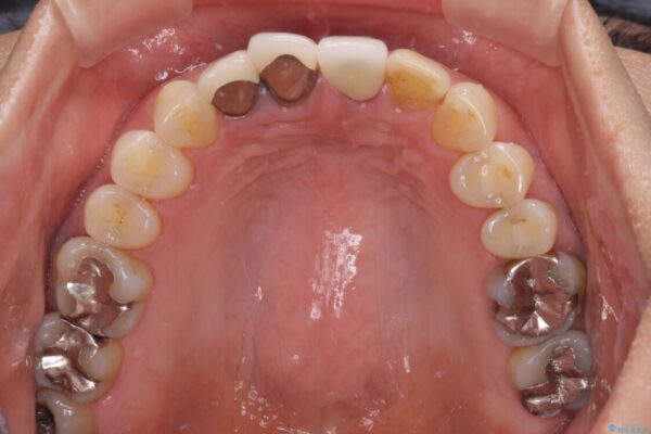 抜かなければいけない前歯　歯肉移植を用いたオールセラミックブリッジ 治療前画像