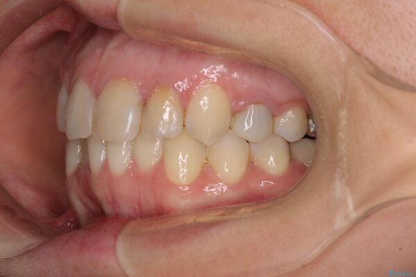 【モニター】前歯のデコボコと奥歯の虫歯　インビザライン治療と奥歯のセラミック治療 治療途中画像