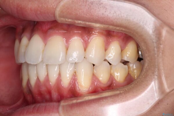 上顎の狭い歯列をインビザラインで拡大 治療後画像