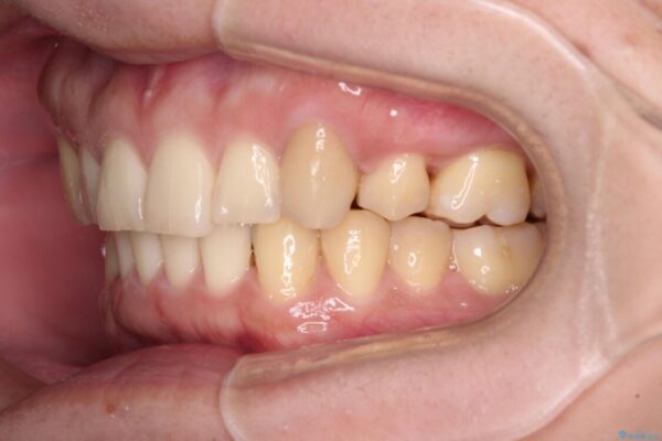 気になる八重歯を抜歯矯正で改善　補助装置を用いたインビザライン矯正 治療後画像