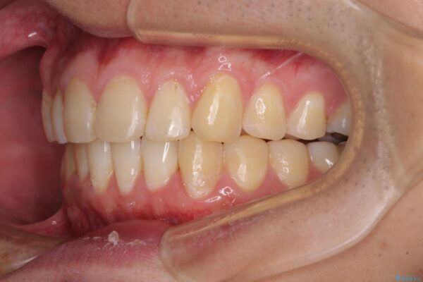 気になる前歯を治したい　短期間でのインビザライン矯正 治療途中画像