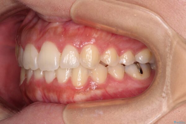 前歯のデコボコをインビザラインでスッキリと 治療後画像