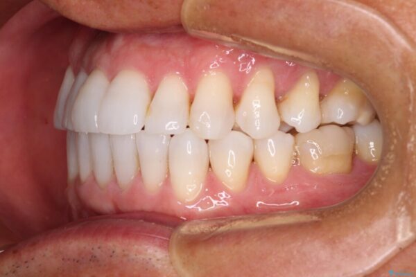 治療途中の前歯を治したい　インビザライン矯正とオールセラミッククラウン 治療後画像