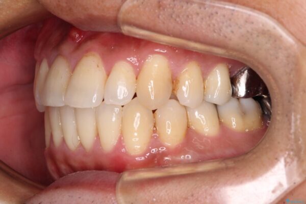 受け口傾向の咬み合わせ　前歯のデコボコをワイヤー矯正で素早く改善 治療後画像