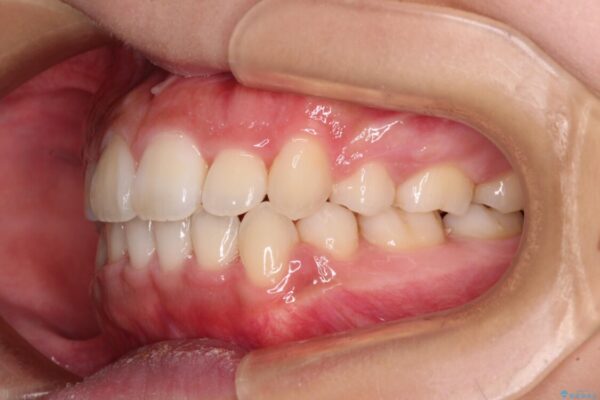気になる八重歯を治したい　目立たないワイヤーでの抜歯矯正 治療後画像