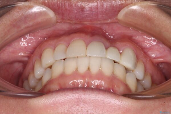 口元の突出感を治したい　治療中の歯も治したい 治療後画像