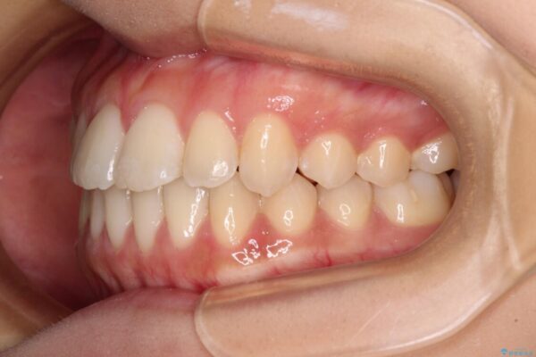 上顎骨拡大を用いたインビザラインによる非抜歯矯正 治療後画像