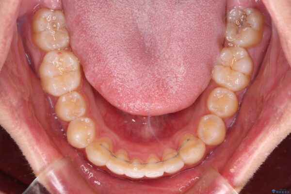 前歯のデコボコと突出感　インビザラインにて矯正治療 治療後画像
