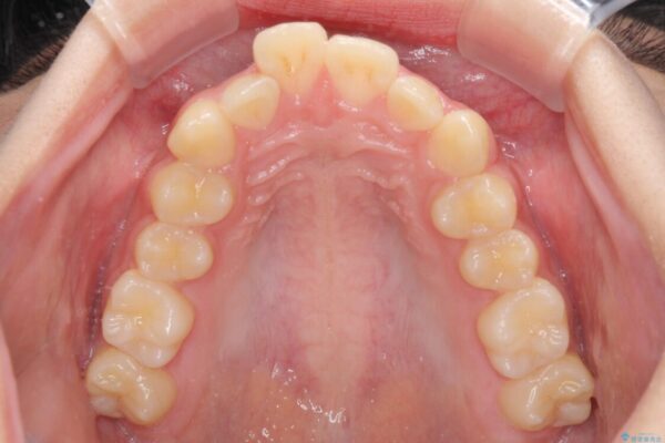 下の前歯が隠れてしまうほど深い咬み合わせ　高校生のインビザライン矯正治療 治療前画像