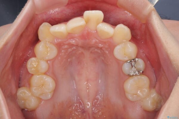 前歯の歯並びを治したい　ワイヤー装置での抜歯矯正 治療前画像