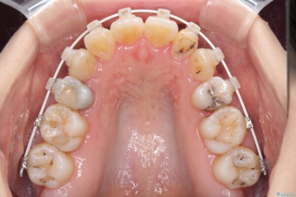 結婚式までに前歯をきれいにしたい　抜歯矯正とオールセラミッククラウン 治療途中画像
