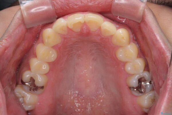 気になる前歯を治したい　短期間でのインビザライン矯正 治療前画像