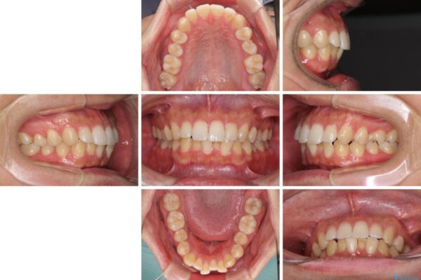 前歯のデコボコと突出感　インビザラインにて矯正治療 治療前画像