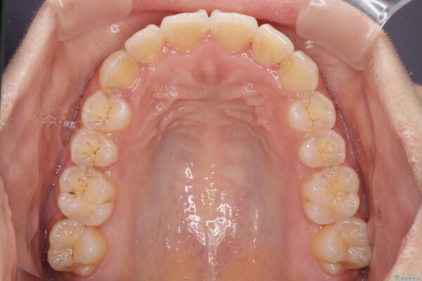 前歯のデコボコをインビザラインでスッキリと 治療途中画像