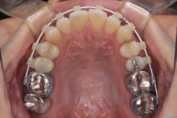 受け口傾向の咬み合わせ　前歯のデコボコをワイヤー矯正で素早く改善 治療途中画像