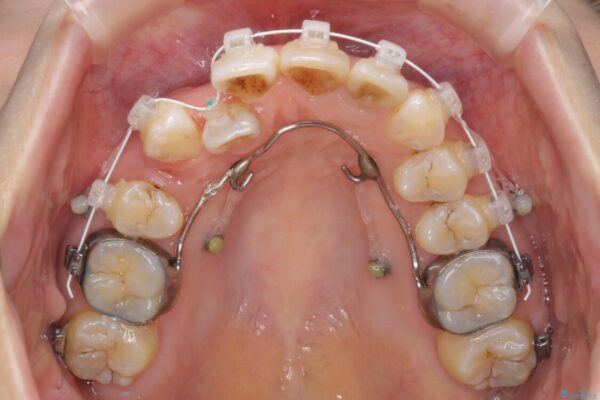 内側にある歯が邪魔　重なった前歯の歯列矯正 治療途中画像