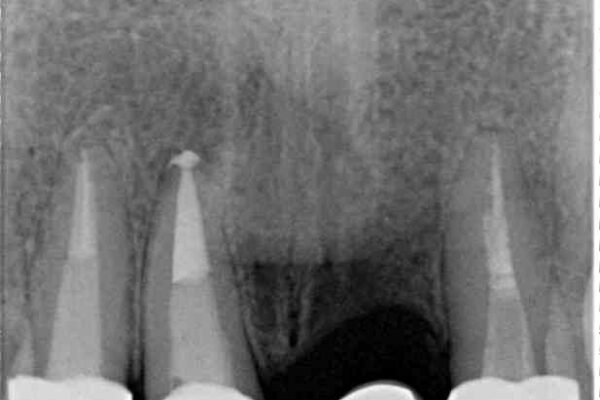 抜かなければいけない前歯　歯肉移植を用いたオールセラミックブリッジ 治療後画像