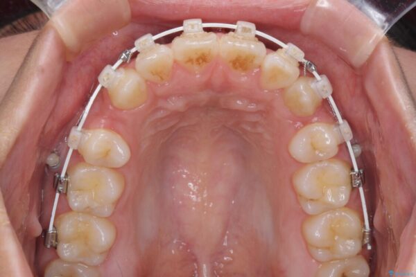 気になる八重歯を治したい　目立たないワイヤーでの抜歯矯正 治療途中画像