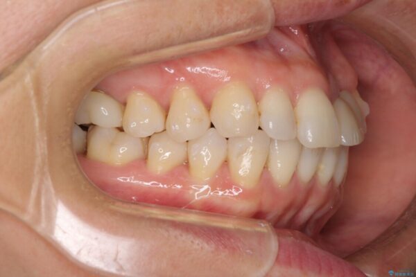 口元の突出感を治したい　治療中の歯も治したい 治療途中画像