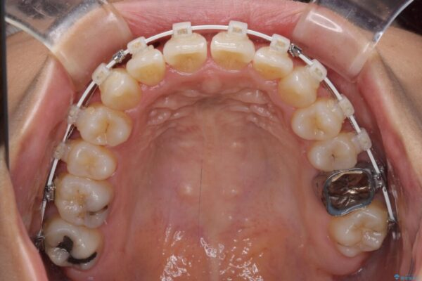 【モニター】幅の狭い上顎歯列　骨幅を拡大する矯正治療 治療途中画像