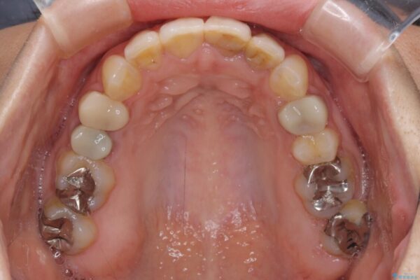 【モニター】前歯のデコボコと奥歯の虫歯　インビザライン治療と奥歯のセラミック治療 治療途中画像