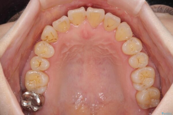 前歯のクロスバイトを治したい　インビザラインによる矯正治療 治療途中画像