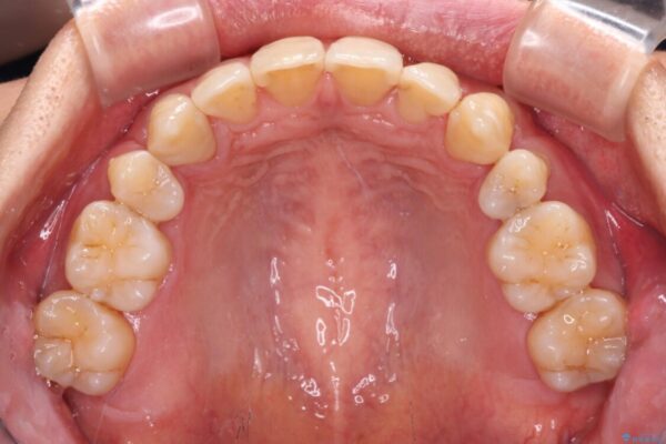 掃除しにくい前歯と閉じにくい口元　目立たないワイヤー装置での抜歯矯正 治療後画像