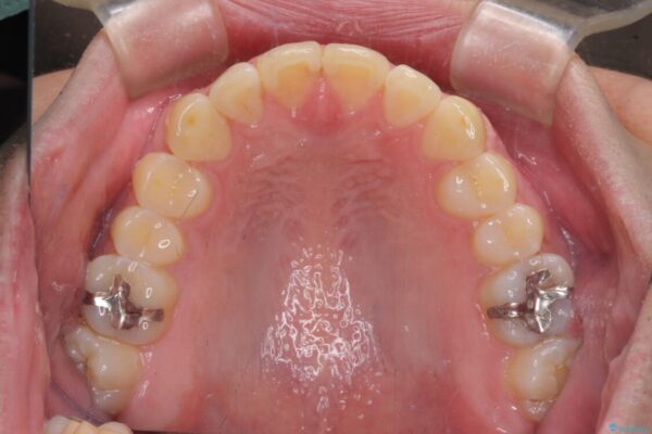 気になる前歯を治したい　短期間でのインビザライン矯正 治療途中画像