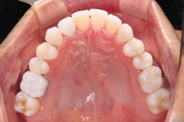 治療途中の前歯を治したい　インビザライン矯正とオールセラミッククラウン 治療後画像