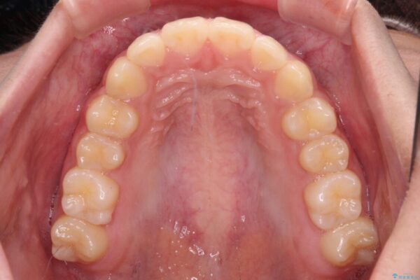 下の前歯が隠れてしまうほど深い咬み合わせ　高校生のインビザライン矯正治療 治療後画像