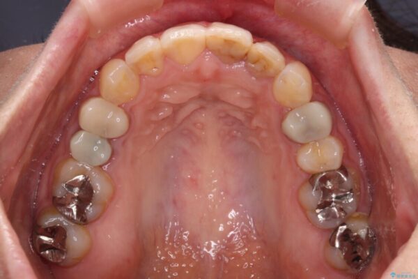 【モニター】前歯のデコボコと奥歯の虫歯　インビザライン治療と奥歯のセラミック治療 治療後画像