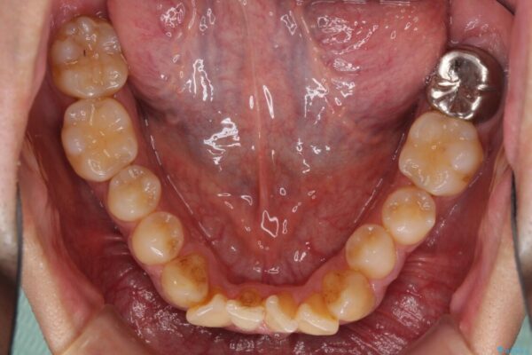 上顎の狭い歯列をインビザラインで拡大 治療前画像