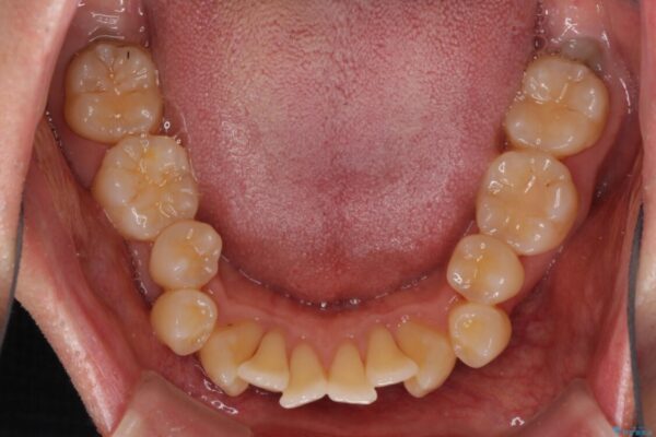 掃除しにくい前歯と閉じにくい口元　目立たないワイヤー装置での抜歯矯正 治療前画像