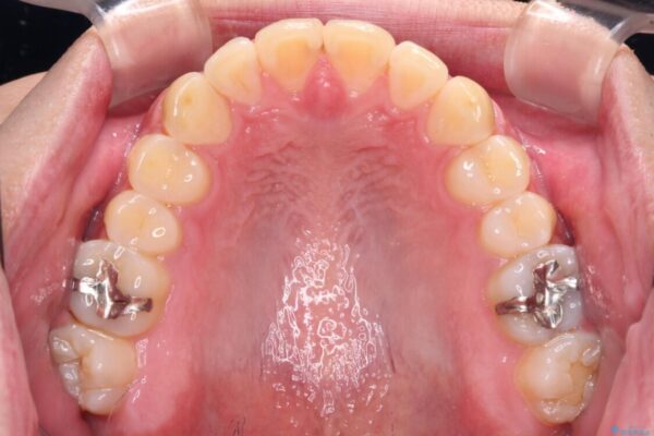 気になる前歯を治したい　短期間でのインビザライン矯正 治療後画像