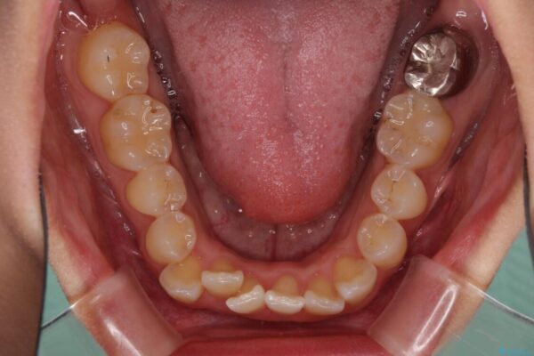 前歯のデコボコをインビザラインでスッキリと仕上げる 治療前画像