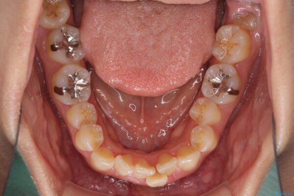 前歯のデコボコをインビザラインでスッキリと 治療前画像