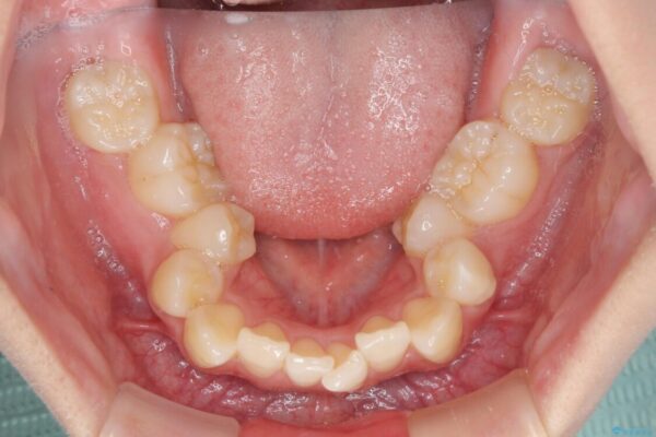 前歯の歯並びを治したい　ワイヤー装置での抜歯矯正 治療前画像