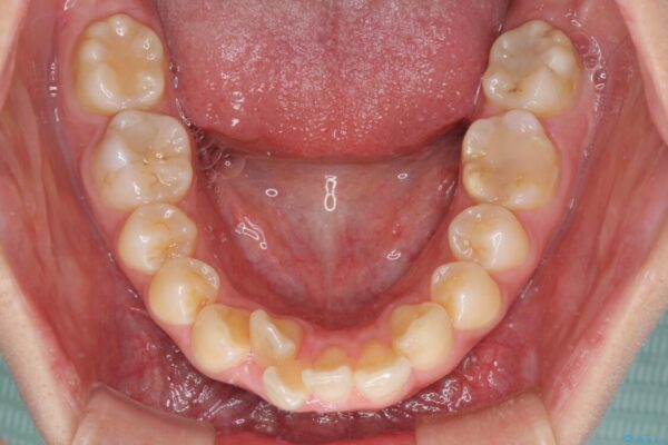 前歯の出っ歯と口の閉じにくさを抜歯矯正で改善　目立たないワイヤー矯正 治療前画像
