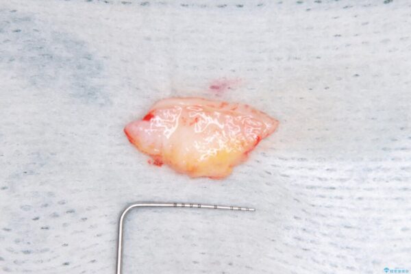 抜かなければいけない前歯　歯肉移植を用いたオールセラミックブリッジ 治療途中画像