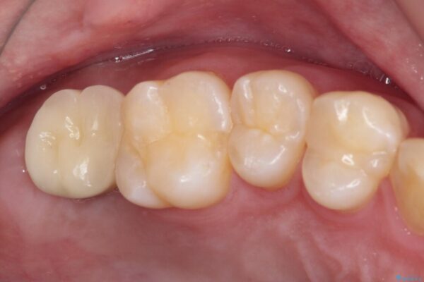 歯に穴を開けられてしまった　インプラントによる奥歯の補綴治療 アフター