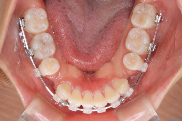 口元の突出感を改善　2年弱での抜歯矯正 治療途中画像