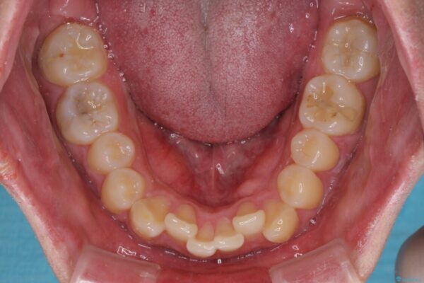 気になる前歯を治したい　短期間でのインビザライン矯正 治療前画像