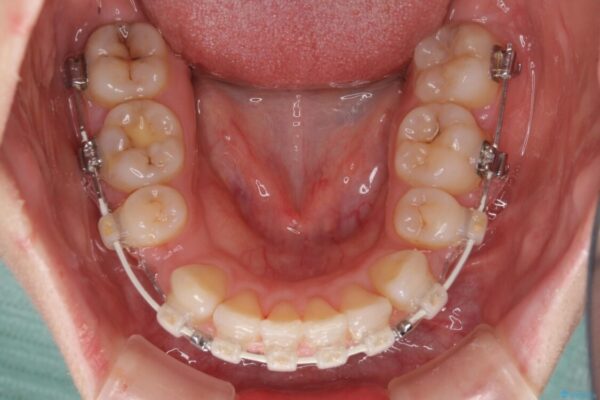 ふっくらとした口元を改善したい　目立たないワイヤー装置による抜歯矯正 治療途中画像