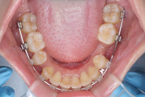 出っ歯を治したい　ワイヤー装置による抜歯矯正 治療途中画像