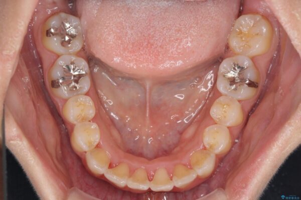 前歯のデコボコをインビザラインでスッキリと 治療途中画像