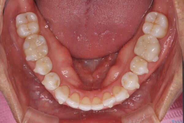 治療途中の前歯を治したい　インビザライン矯正とオールセラミッククラウン 治療途中画像