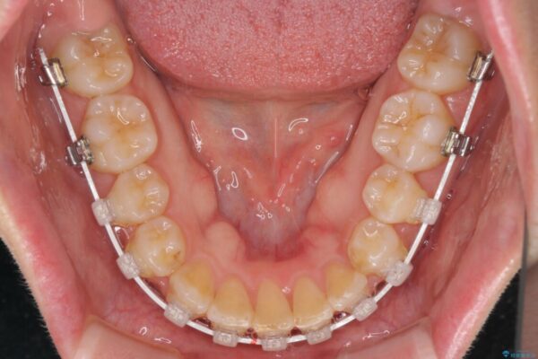変則的な抜歯矯正　八重歯を抜いてしまった人のワイヤー矯正 治療途中画像